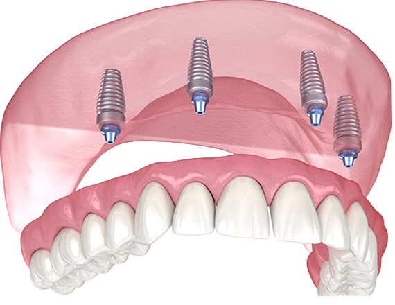 All-on-X Implants